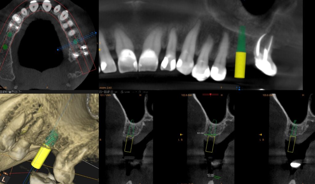 Tomografia zębów podstawą planowania implantów zębów w XXI wieku. PrecisDENT Centrum Implantologii i Stomatologii Mikroskopowej Jasło
